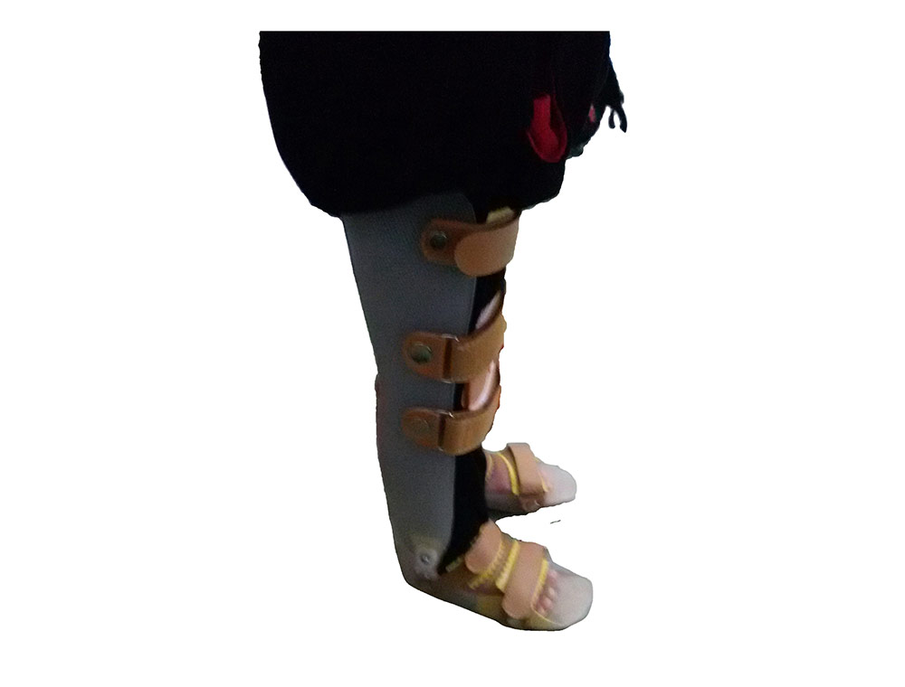 大腿矫形器
